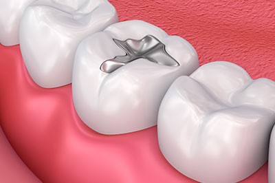The image displays a close-up view of a dental implant with a screw inserted into a tooth, set against a background of a model human mouth with teeth and gums.