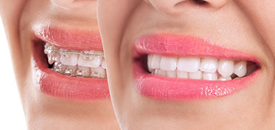 The image features two close-up photographs of a woman smiling broadly with her teeth showing, showcasing a bright smile with braces and lipstick.
