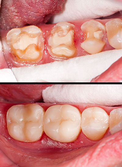 The image shows two photographs of an open mouth with teeth, revealing a dental procedure in progress.