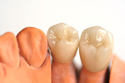 The image shows a set of human teeth with visible fillings, likely for an educational or dental-related context.