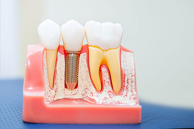 The image shows a close-up of dental implants with visible screws and connectors, set against a red background.
