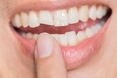 The image shows a person with an open mouth revealing multiple teeth, including a prominent front tooth, and they are holding their finger over the lower lip area.
