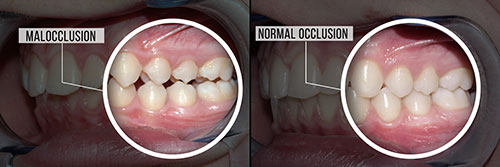 The image shows a composite of three photos displaying a person s teeth with varying degrees of decay and damage, emphasizing the progression from healthy to unhealthy oral conditions, with annotations indicating  Malocclusion  and  No OC,  suggesting a comparison between normal occlusion and occlusal issues.