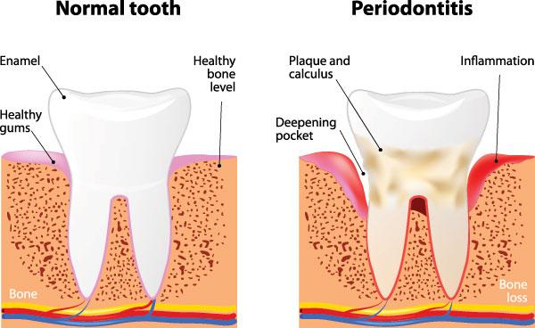 The image shows three stages of tooth decay progression with labels indicating  normal,   periodontitis,  and a close-up view of a damaged tooth with the caption  healthy teeth and gums.