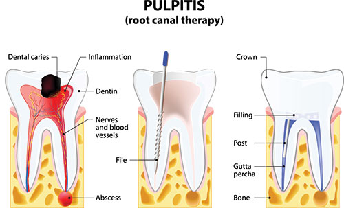 The image displays a detailed illustration of a dental pulpitis process, showing various stages from normal tooth structure to inflammation and infection with labeled anatomical parts such as  root canal,   crown,   dentin,   filing,  and  absorbent.