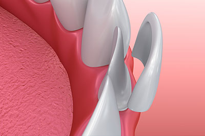 The image displays a close-up view of a dental implant with an artificial tooth root, set against a red background that resembles gum tissue.