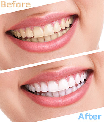 The image shows a before-and-after comparison of teeth whitening treatment, with two photos side by side, one showing teeth before the treatment and the other after, highlighting the improvement in tooth color.