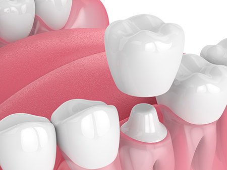 The image shows a close-up view of several teeth with a pink gumline background, emphasizing dental care or oral health products.