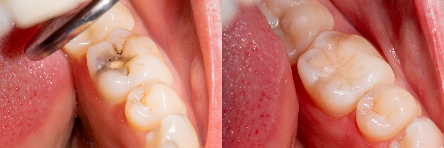 The image shows a close-up view of a dental implant procedure with a focus on the surgical area and tools, highlighting the precision and care involved in the process.