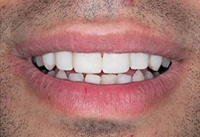 The image shows a close-up of a person s smiling mouth with white teeth, which appears to be an advertisement for dental care or a cosmetic dentist.