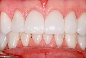 The image shows a close-up view of a person s teeth with a focus on a dental implant, featuring a natural tooth color and texture, set against a contrasting background that highlights the implant s placement in the mouth.