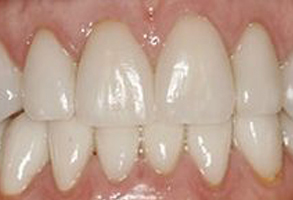 The image shows a close-up of a person s teeth with a focus on a smile, revealing a set of white teeth with some yellowing at the edges, indicating possible dental issues such as staining or decay.