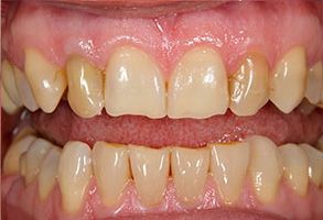 The image shows two photos side by side of a person s teeth with significant discoloration and decay, likely before and after dental treatment.