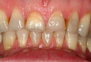 The image shows a close-up view of a person s teeth with visible yellowing and staining, indicating poor oral hygiene or dental issues.