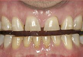 An image displaying a person s mouth with multiple teeth missing, revealing an underlying metal grill or appliance, possibly indicating dental work or treatment.